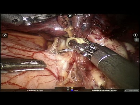Cáncer de pulmón - VAMLA y lobectomía superior izquierda robótica