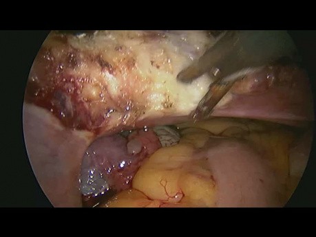Histerectomía laparoscópica total con salpingo bilateral en una paciente con cesárea previa