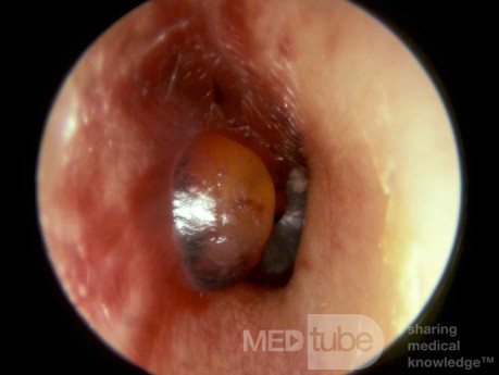 Miringitis bullosa, caso 1