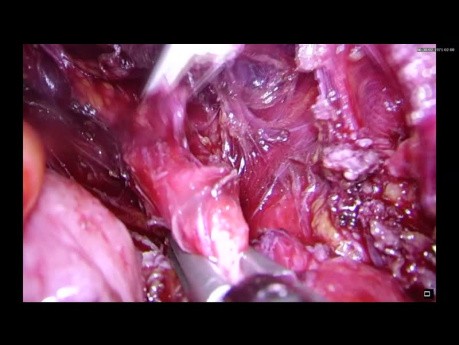 Endometriosis Rectal