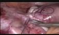 Miomectomía por vía laparoscópica por un mioma en el ligamento ancho del útero