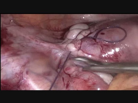 Miomectomía por vía laparoscópica por un mioma en el ligamento ancho del útero