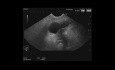 Ecografía endoscópica para la neoplasia mucinosa papilar intraductal (NMPI) pancreático