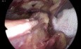 Anatomía inguinal en la reparación de hernia TAPP