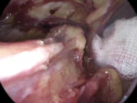 Anatomía inguinal en la reparación de hernia TAPP
