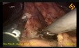 Gastrectomía distal laparoscópica con linfadenectomía D2