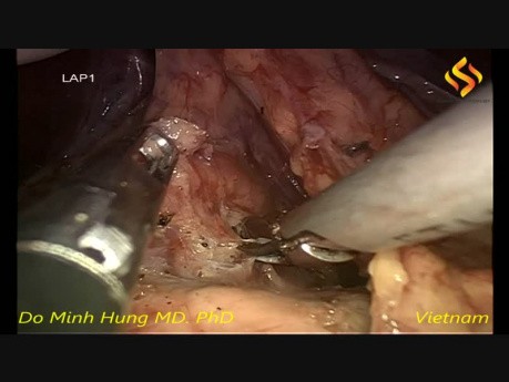Gastrectomía distal laparoscópica con linfadenectomía D2