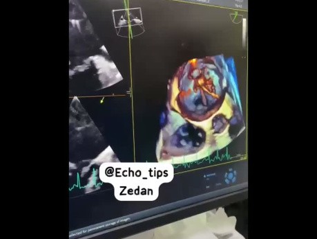 Ecocardiografía transesofágica 3D en valvuloplastia mitral percutánea con balón
