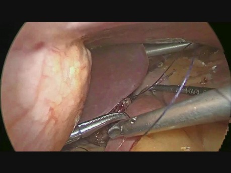 Bypass gástrico de una anastomosis