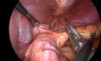 Gastrectomía en cuña de GIST subcárdico