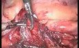 Apendicectomía laparoscópica   