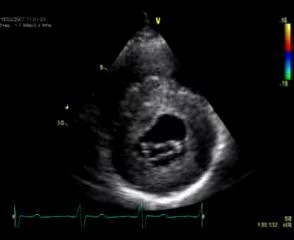 Miocardiopatía hipertrófica