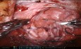 TARM robótico de arriba hacia abajo para hernia incisional suprapúbica después de varias cesáreas