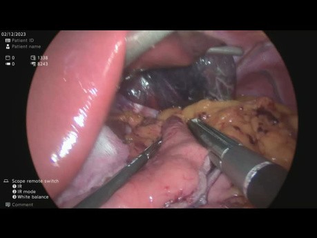 Bypass gástrico laparoscópico de una anastomosis más reparación de hernia de hiato y colecistectomía