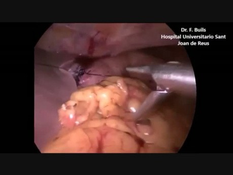 Tratamiento laparoscópico para úlcera gástrica sangrante perforada