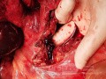 Trombosis venosa mesentérica