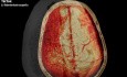 Craneotomía osteoplástica en un caso de hemorragia subdural espontánea aguda