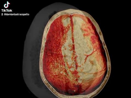 Craneotomía osteoplástica en un caso de hemorragia subdural espontánea aguda