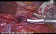 Manejo laparoscópico del estómago totalmente intratorácico