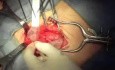 Reparación de hernia inguinal con malla