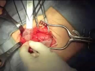 Reparación de hernia inguinal con malla