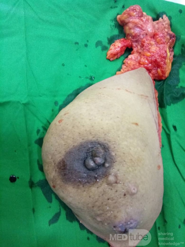 Mismo seno después de quimiorradioterapia neoadyuvante