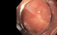 Disección submucosa endoscópica de adenoma recto residual