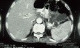 Cáncer de páncreas - 1