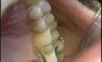 Limpieza dental por ultrasonidos
