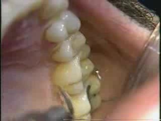 Limpieza dental por ultrasonidos