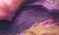 Gastrostomia laparoscopica en cancer de esofago estenuante