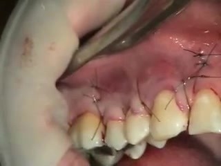 Tratamiento de las recesiones gingivales mediante injertos de tejido conectivo 