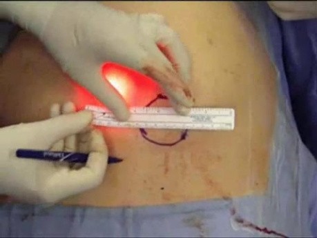 Reparación laparoscópica de doble hernia