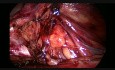 TEP para hernia inguinal directa bilateral