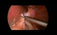 Reparación laparoscópica de hernia hiatal recurrente con malla sintética