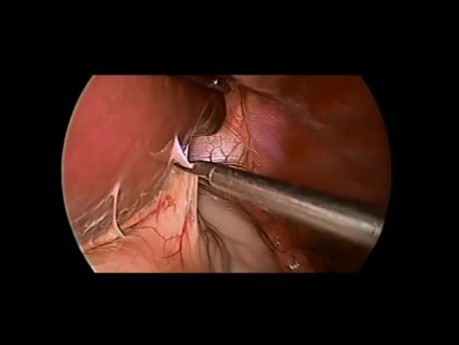 Reparación laparoscópica de hernia hiatal recurrente con malla sintética