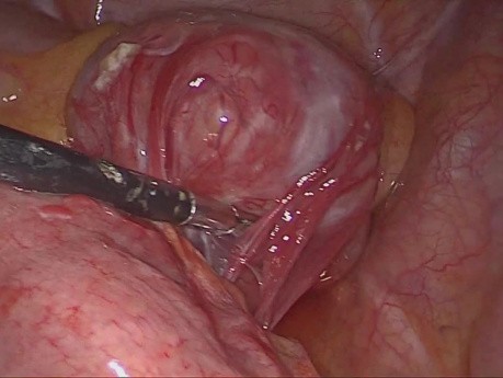 Resección laparoscópica en cuña de un tumor del estroma de yeyuno
