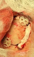 Estirpación de cavernoma subcortical 