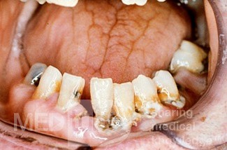 Cálculo dental
