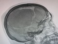 Craniectomía descompresiva en infarto maligno de la arteria cerebral media