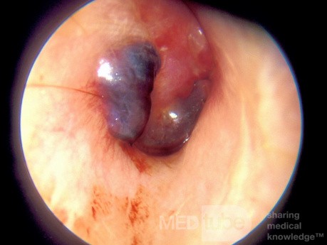 Miringitis bullosa con ampolla llena de sangre