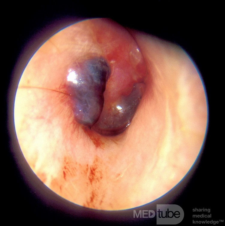 Miringitis bullosa con ampolla llena de sangre
