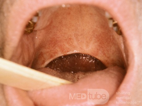 Uvulopalatoplastia