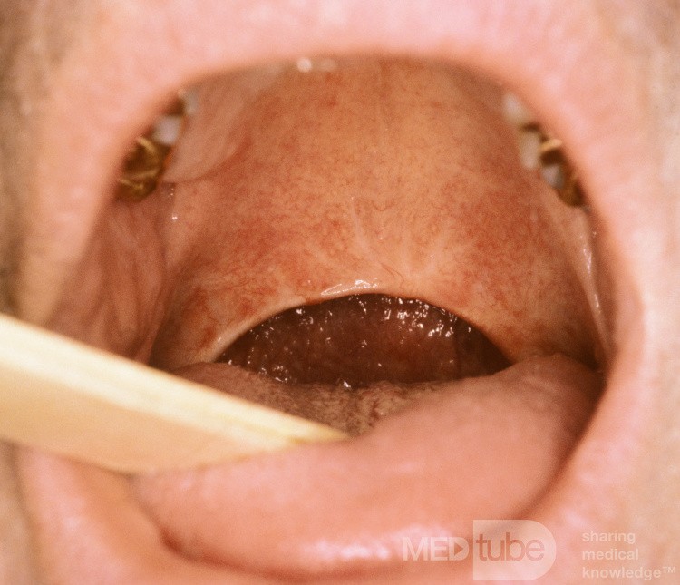 Uvulopalatoplastia