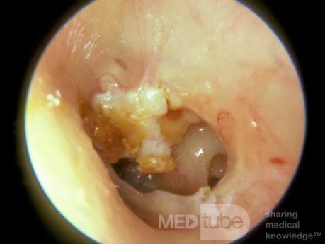 Colesteatoma