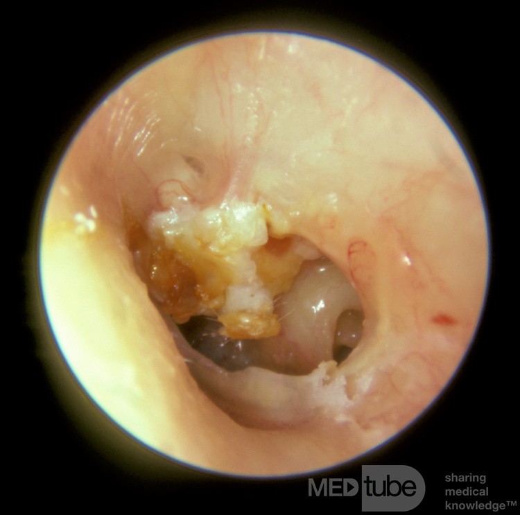 Colesteatoma