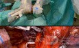 Cirugía robótica para el cáncer de pulmón