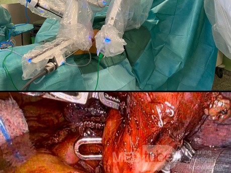 Cirugía robótica para el cáncer de pulmón
