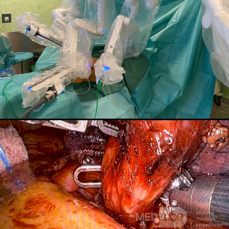 Cirugía robótica para el cáncer de pulmón