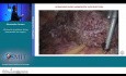 Ultrasound as Guidance During Laparoscopic Liver Surgery